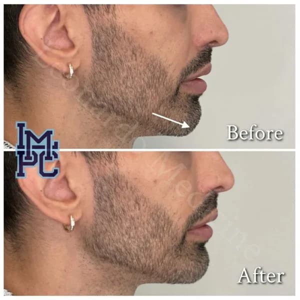 Lower Face Filler treatment 24