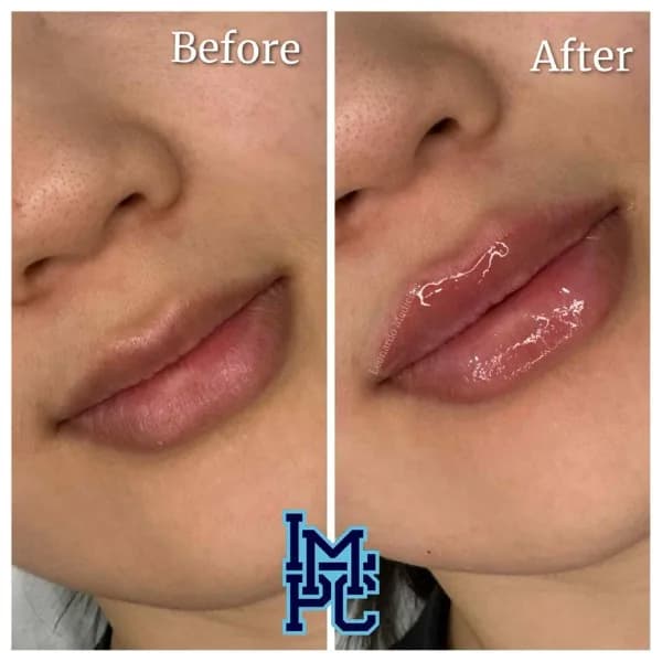 Lower Face Filler treatment 25