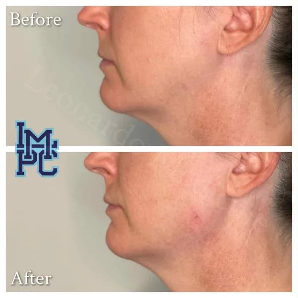 Lower Face Filler treatment 26