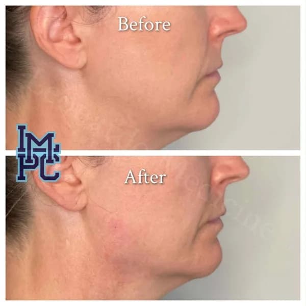 Lower Face Filler treatment 27