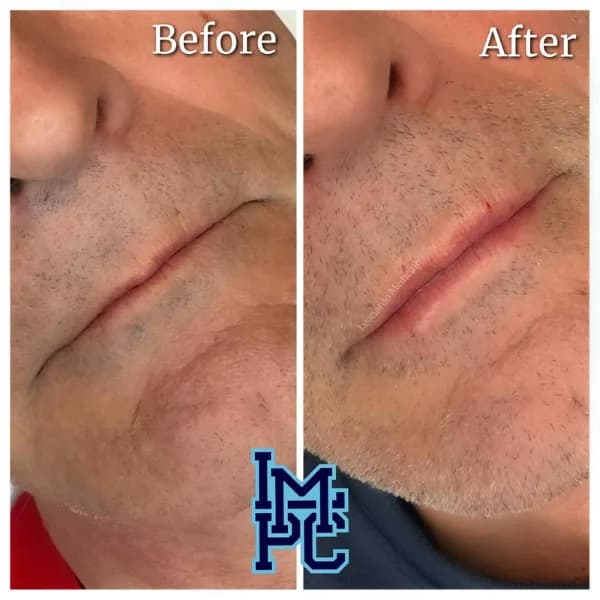 Lower Face Filler treatment 28