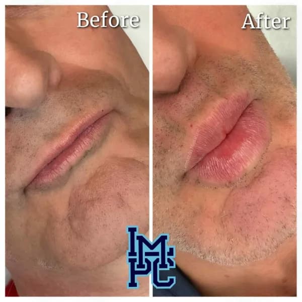 Lower Face Filler treatment 29