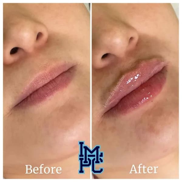 Lower Face Filler treatment 3