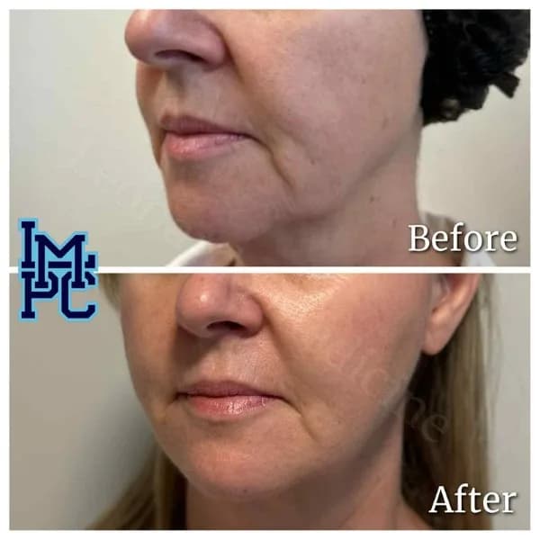 Lower Face Filler treatment 30