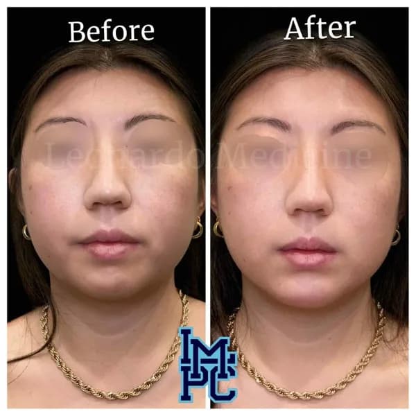Lower Face Filler treatment 31