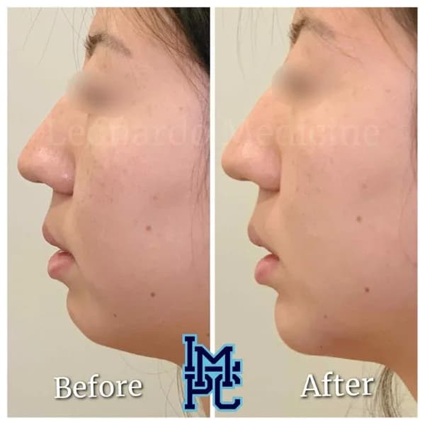 Lower Face Filler treatment 33