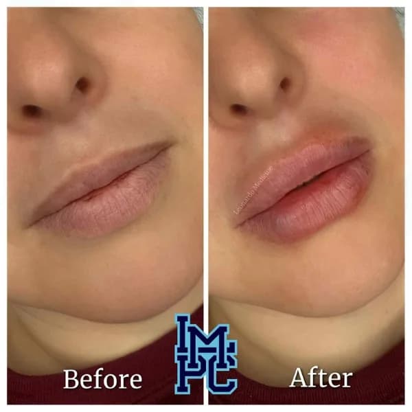 Lower Face Filler treatment 34