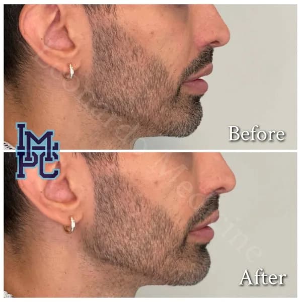 Lower Face Filler treatment 35