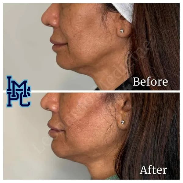 Lower Face Filler treatment 36