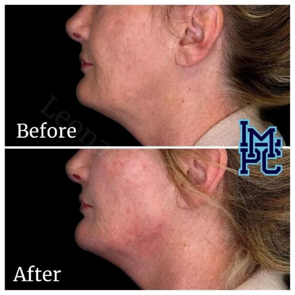 Lower Face Filler treatment 37