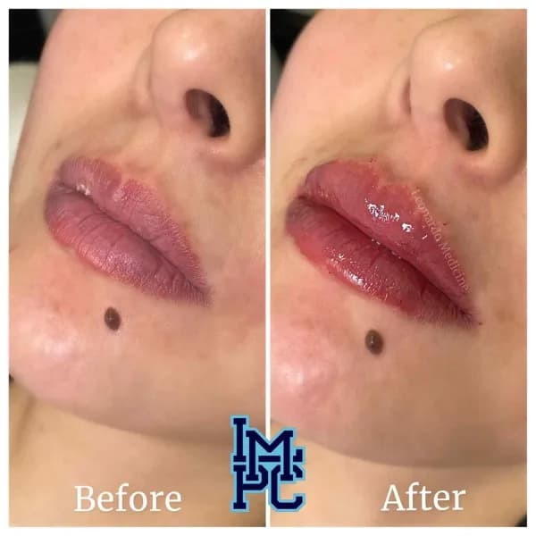 Lower Face Filler treatment 38