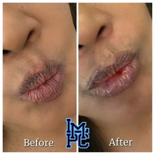 Lower Face Filler treatment 39