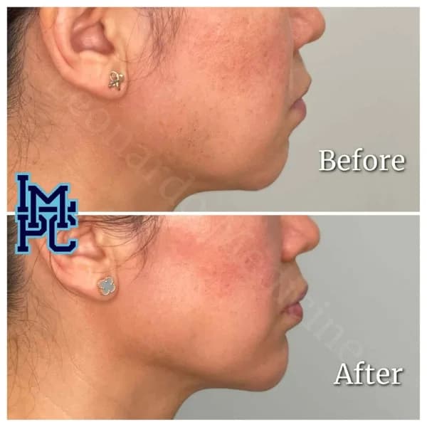 Lower Face Filler treatment 4