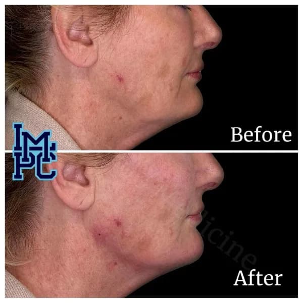 Lower Face Filler treatment 40