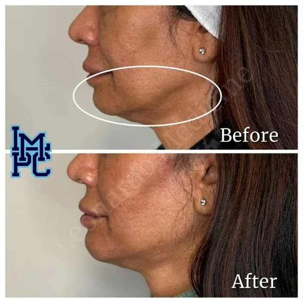 Lower Face Filler treatment 41