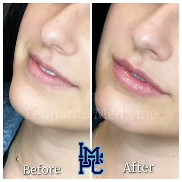 Lower Face Filler treatment 42