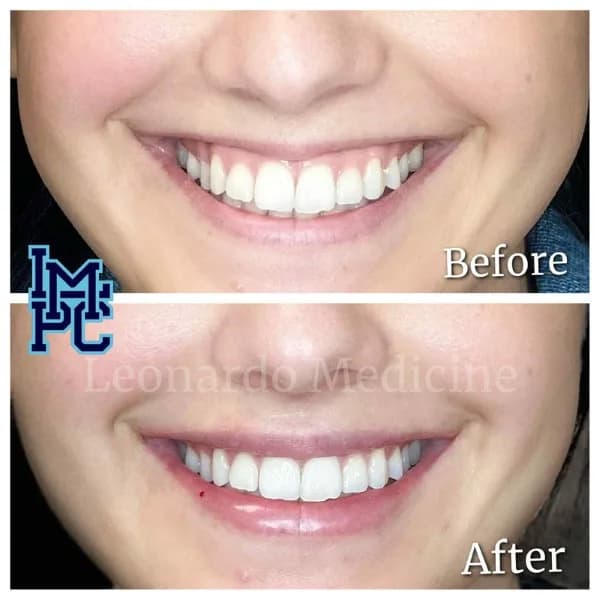 Lower Face Filler treatment 43