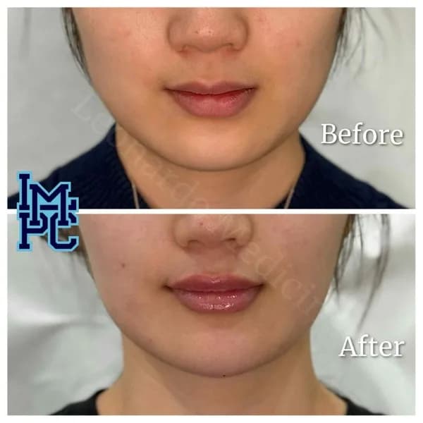 Lower Face Filler treatment 45