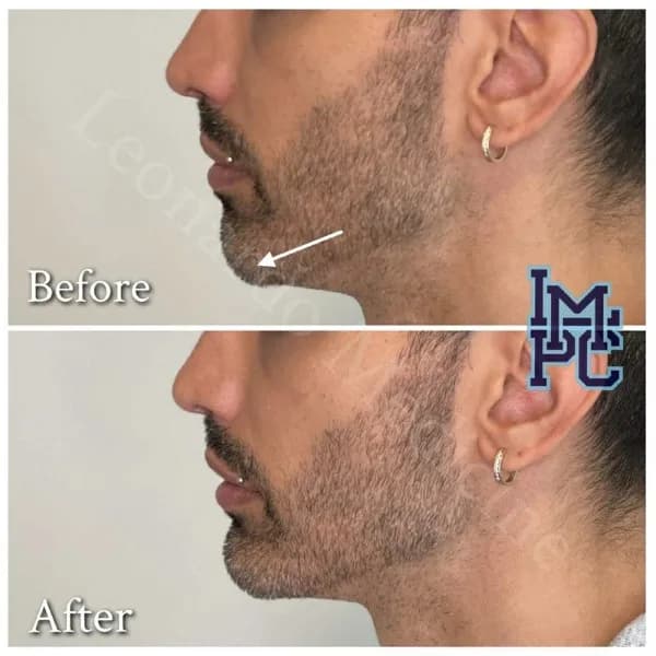 Lower Face Filler treatment 46