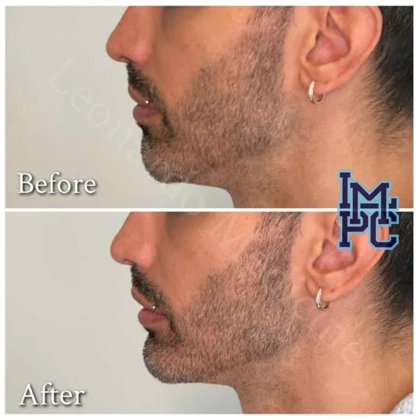 Lower Face Filler treatment 47