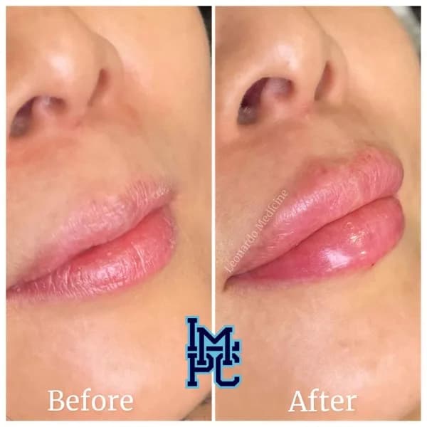 Lower Face Filler treatment 48