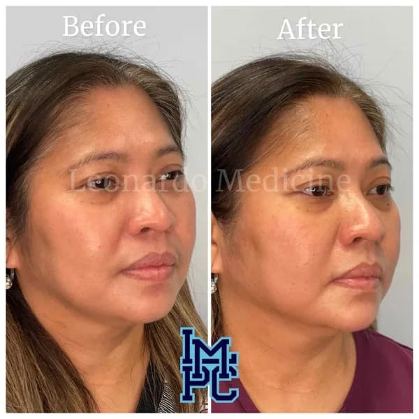 Lower Face Filler treatment 49