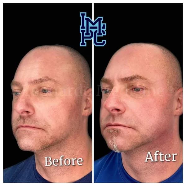 Lower Face Filler treatment 5