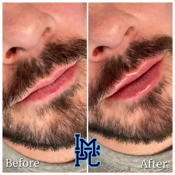 Lower Face Filler treatment 51