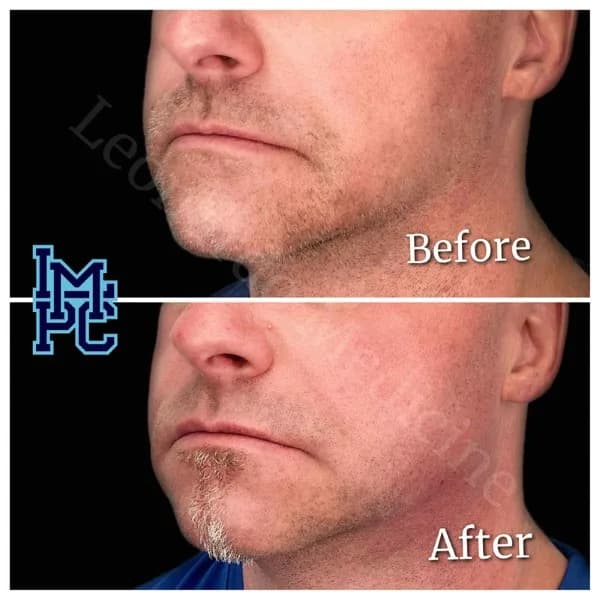 Lower Face Filler treatment 6