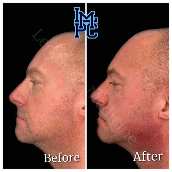 Lower Face Filler treatment 7