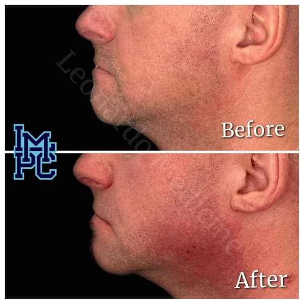 Lower Face Filler treatment 8