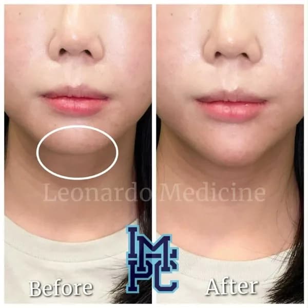Lower Face Filler treatment 9