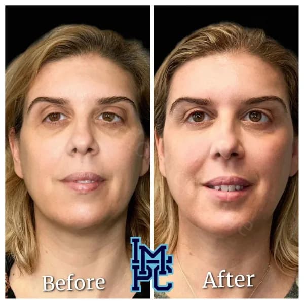 Pan Face Filler treatment 1