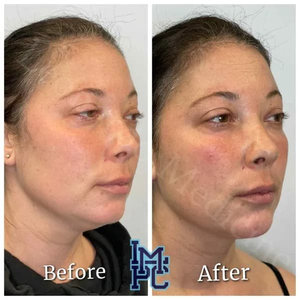 Pan Face Filler treatment 12