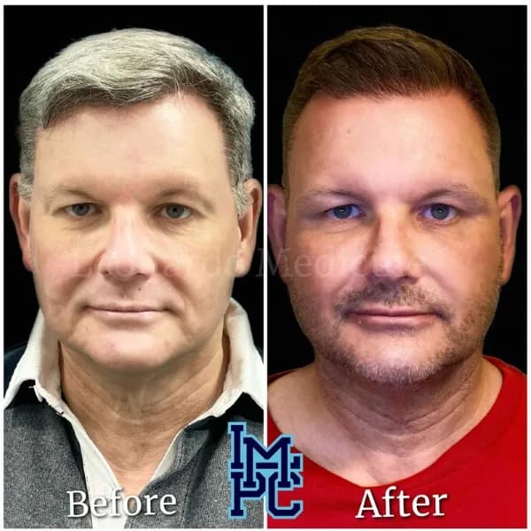 Pan Face Filler treatment 13