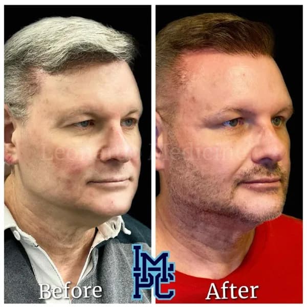 Pan Face Filler treatment 14