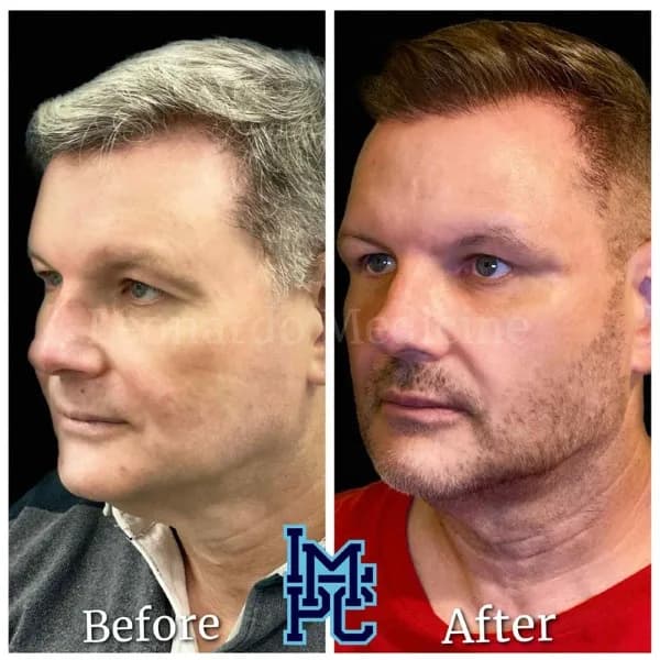 Pan Face Filler treatment 15