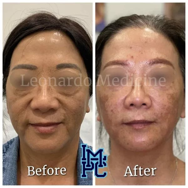 Pan Face Filler treatment 16