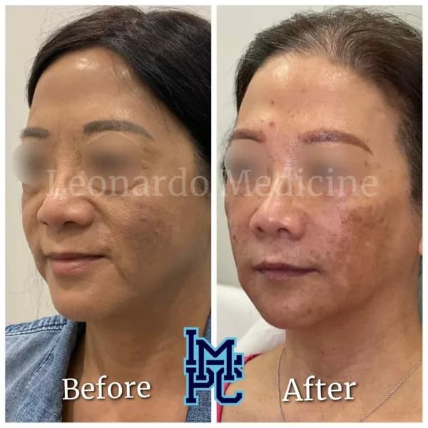 Pan Face Filler treatment 17