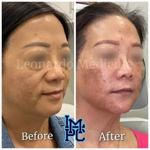 Pan Face Filler treatment 18