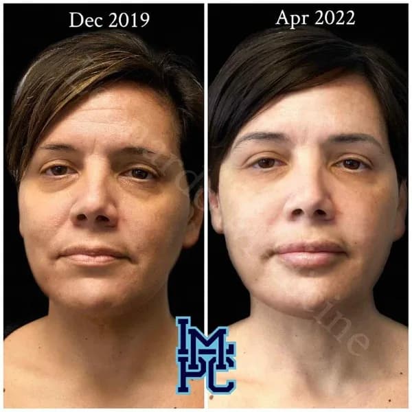 Pan Face Filler treatment 19