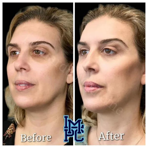 Pan Face Filler treatment 2