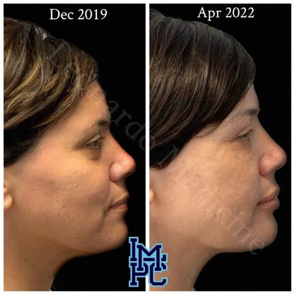 Pan Face Filler treatment 21