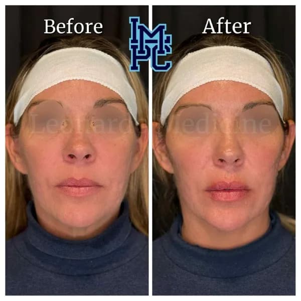 Pan Face Filler treatment 22