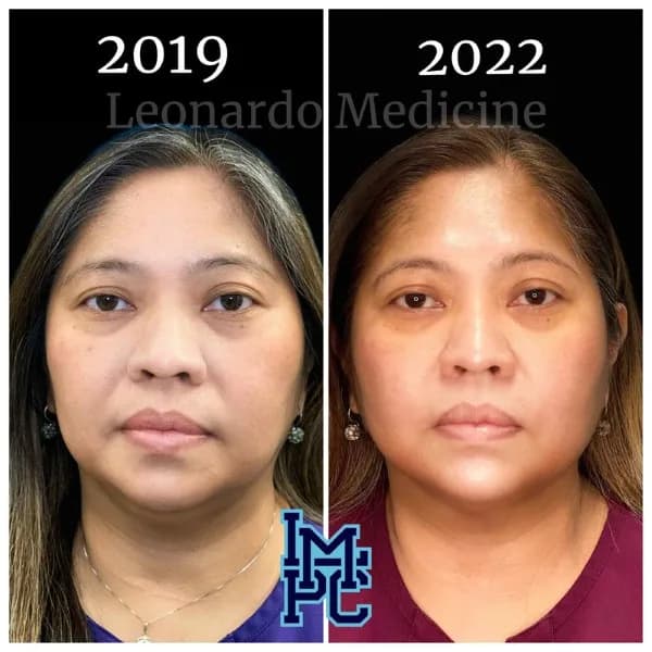 Pan Face Filler treatment 23