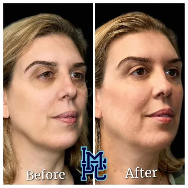 Pan Face Filler treatment 3