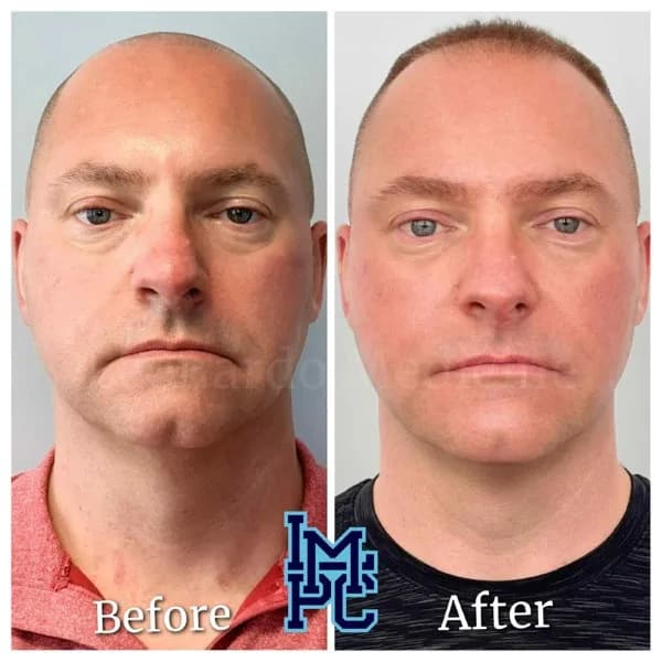 Pan Face Filler treatment 5