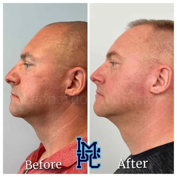 Pan Face Filler treatment 8