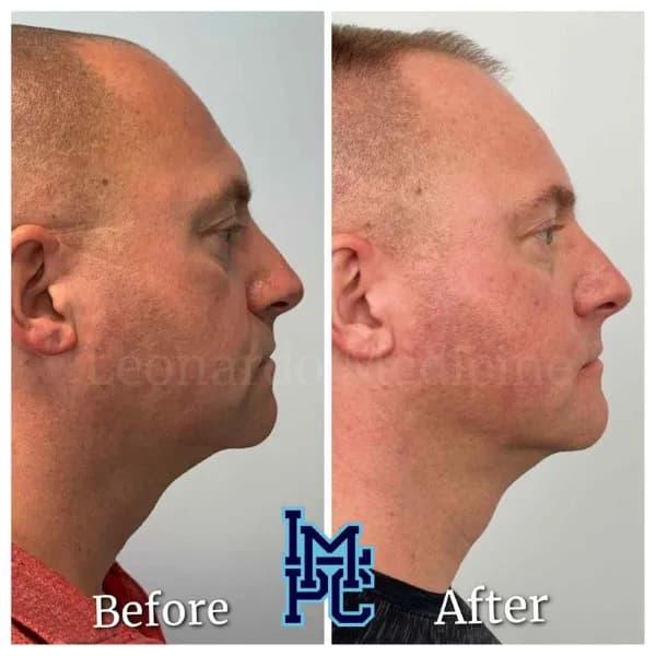 Pan Face Filler treatment 9