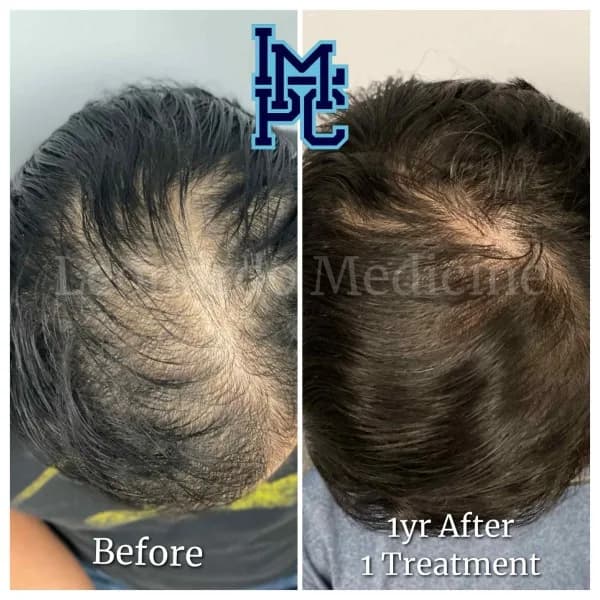 PRP Hair Treatment case 10